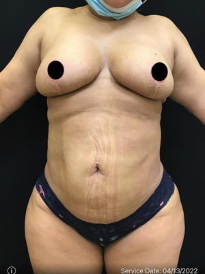 Liposuction