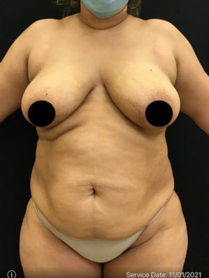 Liposuction