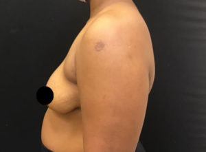 Breast Augmentation