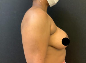 Breast Augmentation