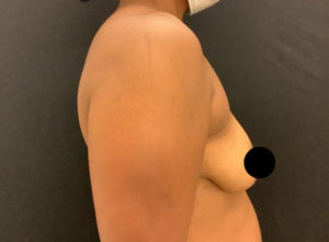 Breast Augmentation