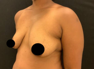Breast Augmentation