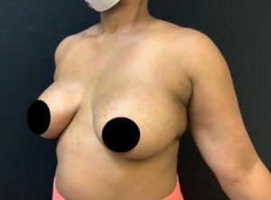 Breast Augmentation