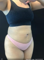 Tummy Tuck