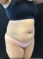 Tummy Tuck