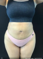 Tummy Tuck