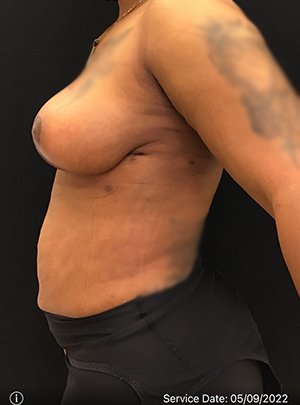 Breast Lift