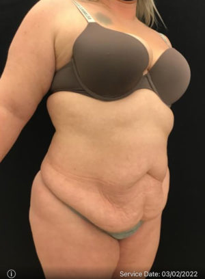 Mini Tummy Tuck