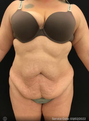 Mini Tummy Tuck