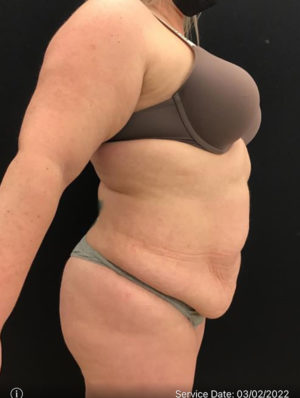 Mini Tummy Tuck