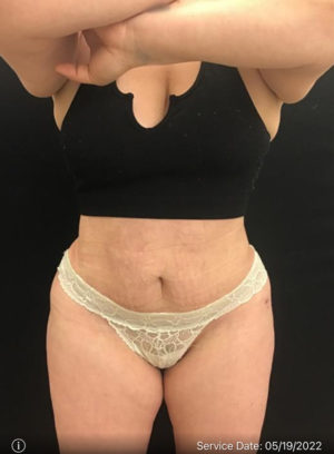 Mini Tummy Tuck