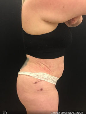 Mini Tummy Tuck