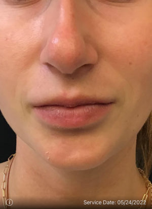 Juvederm