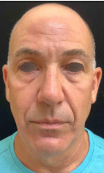 Under Eye Rejuvenation