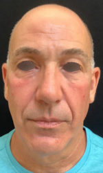 Under Eye Rejuvenation