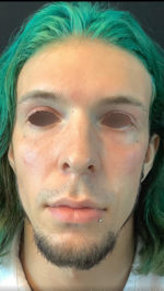 Under Eye Rejuvenation