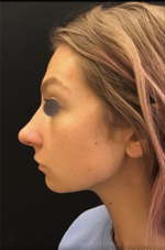Nose Surgery