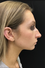 Nose Surgery