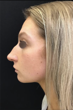 Nose Surgery