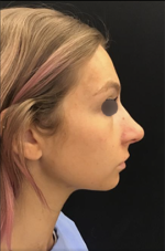 Nose Surgery