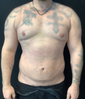 Gynecomastia