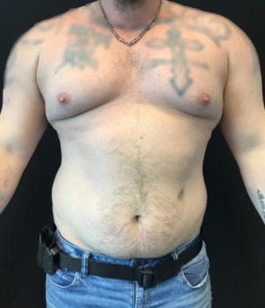 Gynecomastia