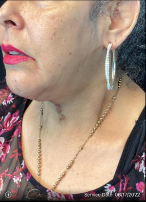 Neck Lift