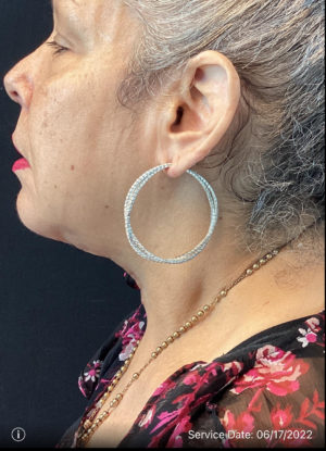 Neck Lift