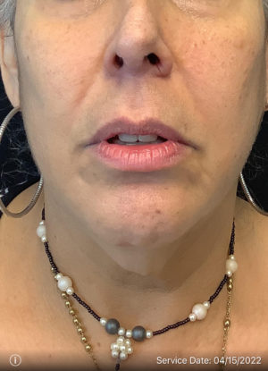 Neck Lift