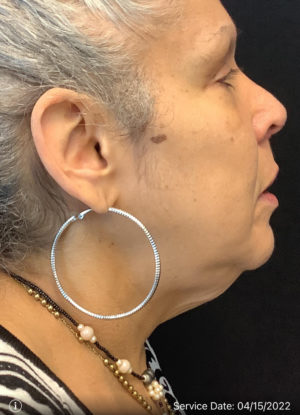 Neck Lift