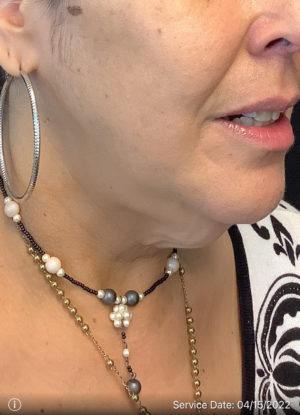 Neck Lift
