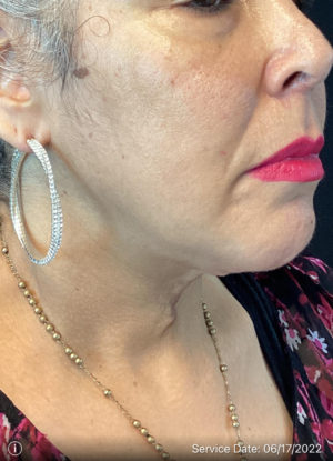 Neck Lift