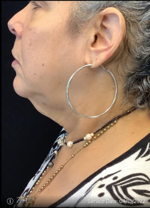 Neck Lift