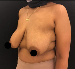 Breast Lift