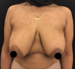 Breast Lift