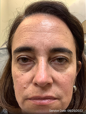 Around The Eye Fillers