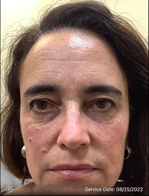 Around The Eye Fillers