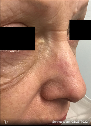 Basal Cell Carcinoma