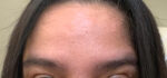 Botox Cosmetic and Dysport