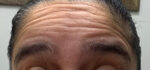Botox Cosmetic and Dysport