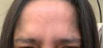 Botox Cosmetic and Dysport