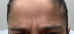 Botox Cosmetic and Dysport