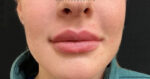 Lip Augmentation