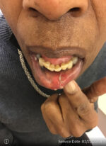 Facial Reconstruction