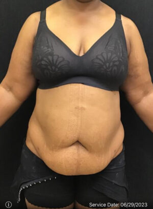 Tummy Tuck