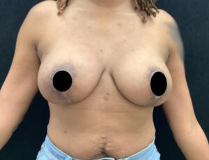 Breast Augmentation