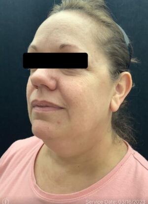 Liposuction Under Chin