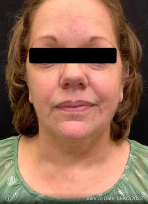 Liposuction Under Chin