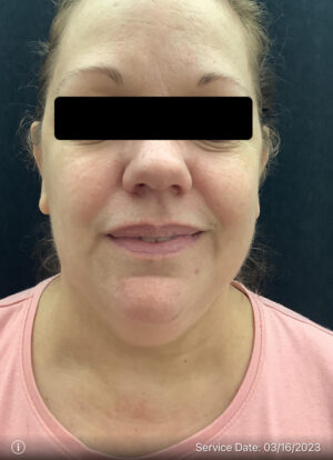 Liposuction Under Chin