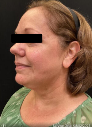 Liposuction Under Chin